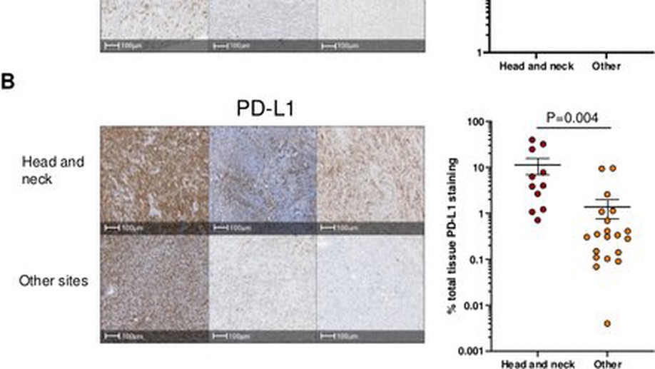 Anti-PD-1 elicits regression of undifferentiated pleomorphic sarcomas with UV-mutation signatures